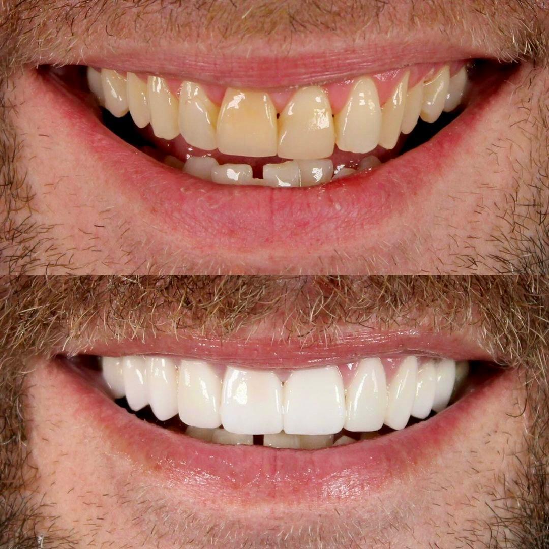 Implantes dentales: procedimiento quirúrgico y recuperación