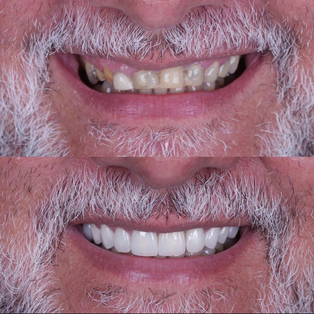 Injertos óseos dentales: tipos, indicaciones y postoperatorio